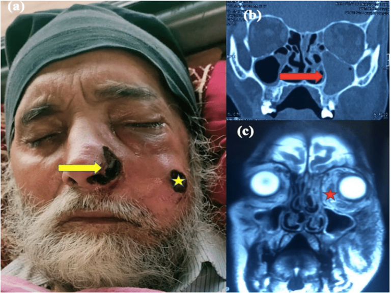 Clinical-radiological-images-of-a-60-year-old-male-with-mucormycosis-and-skin (1)